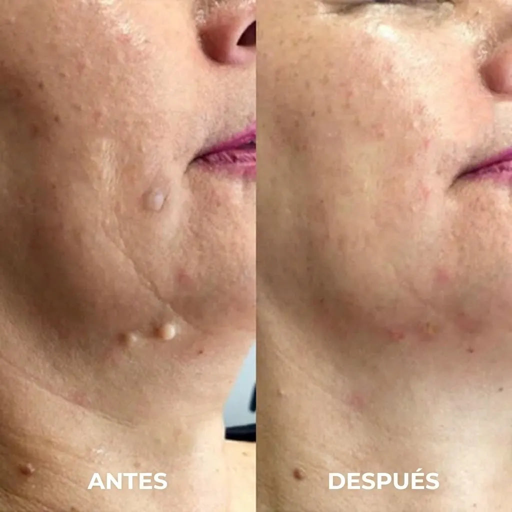 DermaTouch™ Lápiz Eliminador de Verrugas