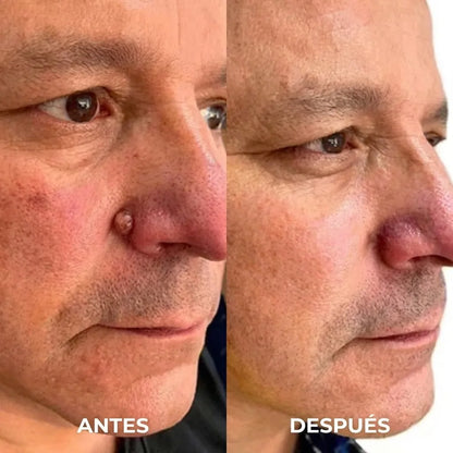 DermaTouch™ Lápiz Eliminador de Verrugas