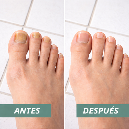 Una forma natural de eliminar los hongos en las uñas para siempre