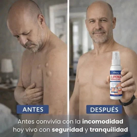 SinLipomas™ Spray Removedor de Lipmomas
