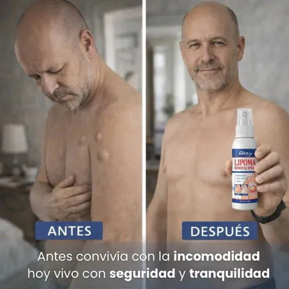 SinLipomas™ Spray Removedor de Lipmomas