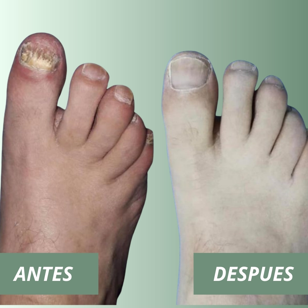 Una forma natural de eliminar los hongos en las uñas para siempre