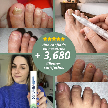 Una forma natural de eliminar los hongos en las uñas para siempre
